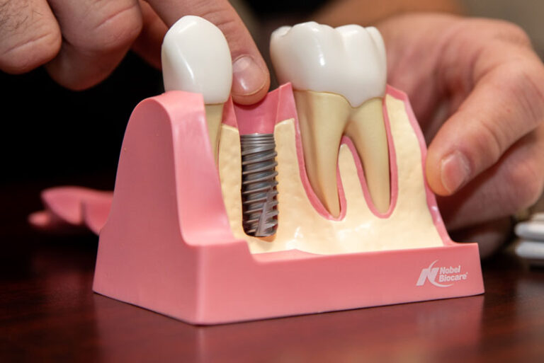 Doctor Showing Off Dental Implant Model