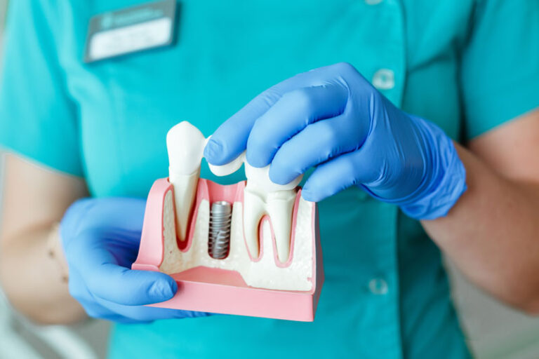 3D illustration of a single-tooth dental implant demonstrates each procedure component—implant, abutment, and crown- separately.