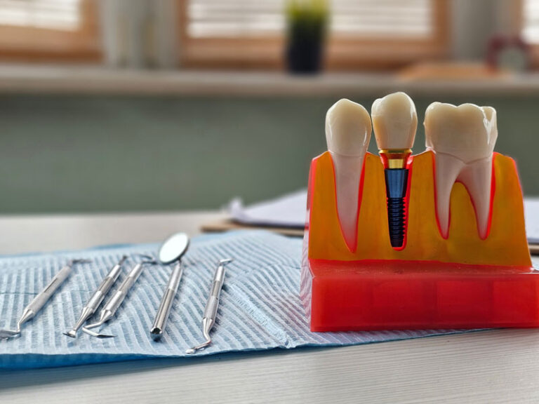 Dental implant, artificial tooth roots into jaw, root canal of dental treatment, gum disease, teeth model for dentist