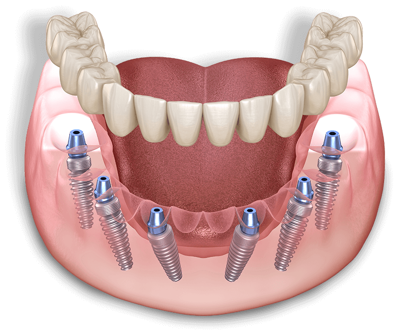 Dental Implants