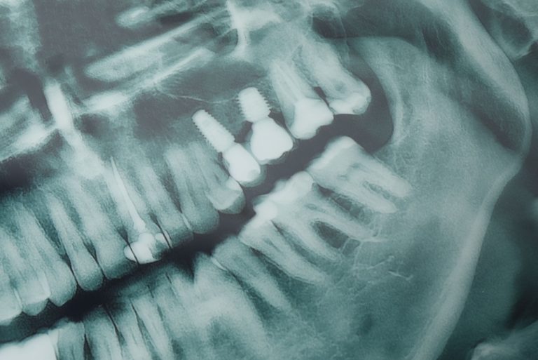 Close up image of a dental implant, showing the three main parts: the titanium implant fixture in the bone, the abutment connecting the fixture, and the crown on top. No text on the image.