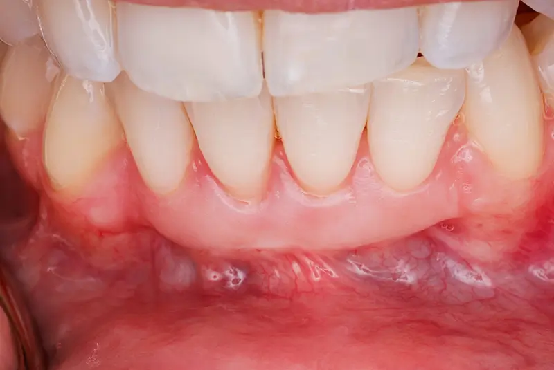 gum-grafting-new after-img