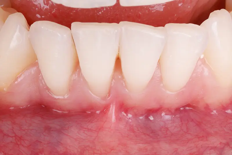 gum-grafting-new before-img